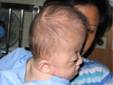 ผู้ป่วยกลุ่มอาการเอเพิร์ต (Apert syndrome)